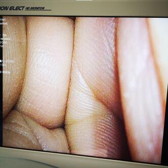 Olympus Endoeye flex 3D Laparoscopic Video - 7