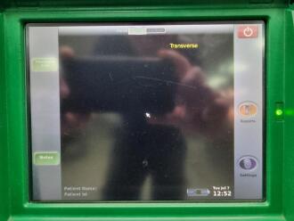 Bardscan IIs Bladder Scanner on Rollstand - 2