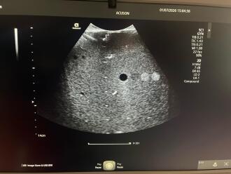 Siemens Healthineers Acuson Redwood Ultrasound System - 17