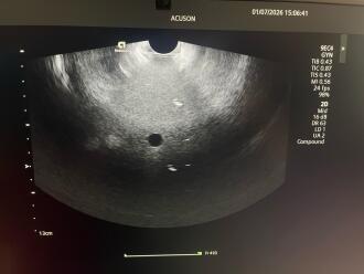 Siemens Healthineers Acuson Redwood Ultrasound System - 18