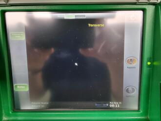 Bardscan IIs Bladder Scanner - 2