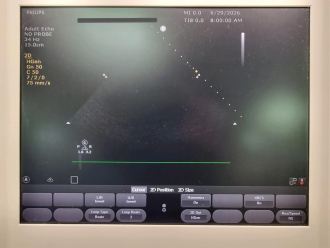 Philips CX50 Portable Ultrasound on Philips CX Trolley - No HDD - 4