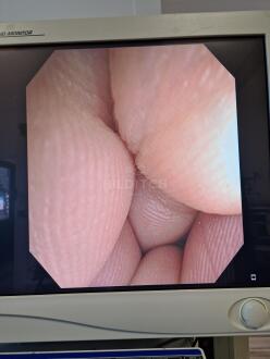 Olympus CF-Q145I Colonoscope - 11